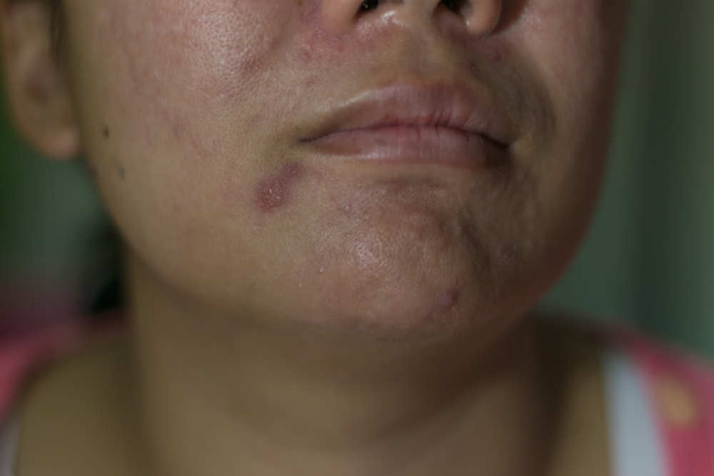 7 Cara Merawat Kulit Sensitif dan Mengenalinya