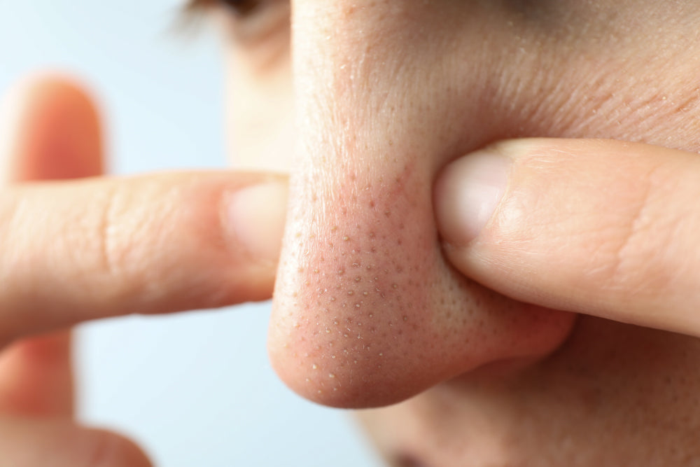 5 Cara Menghilangkan Bruntusan di Hidung dan Wajah yang Tepat dan Aman